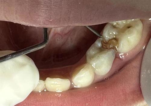 补牙洞的视频,从清洁到修复，一图看懂牙齿美容术